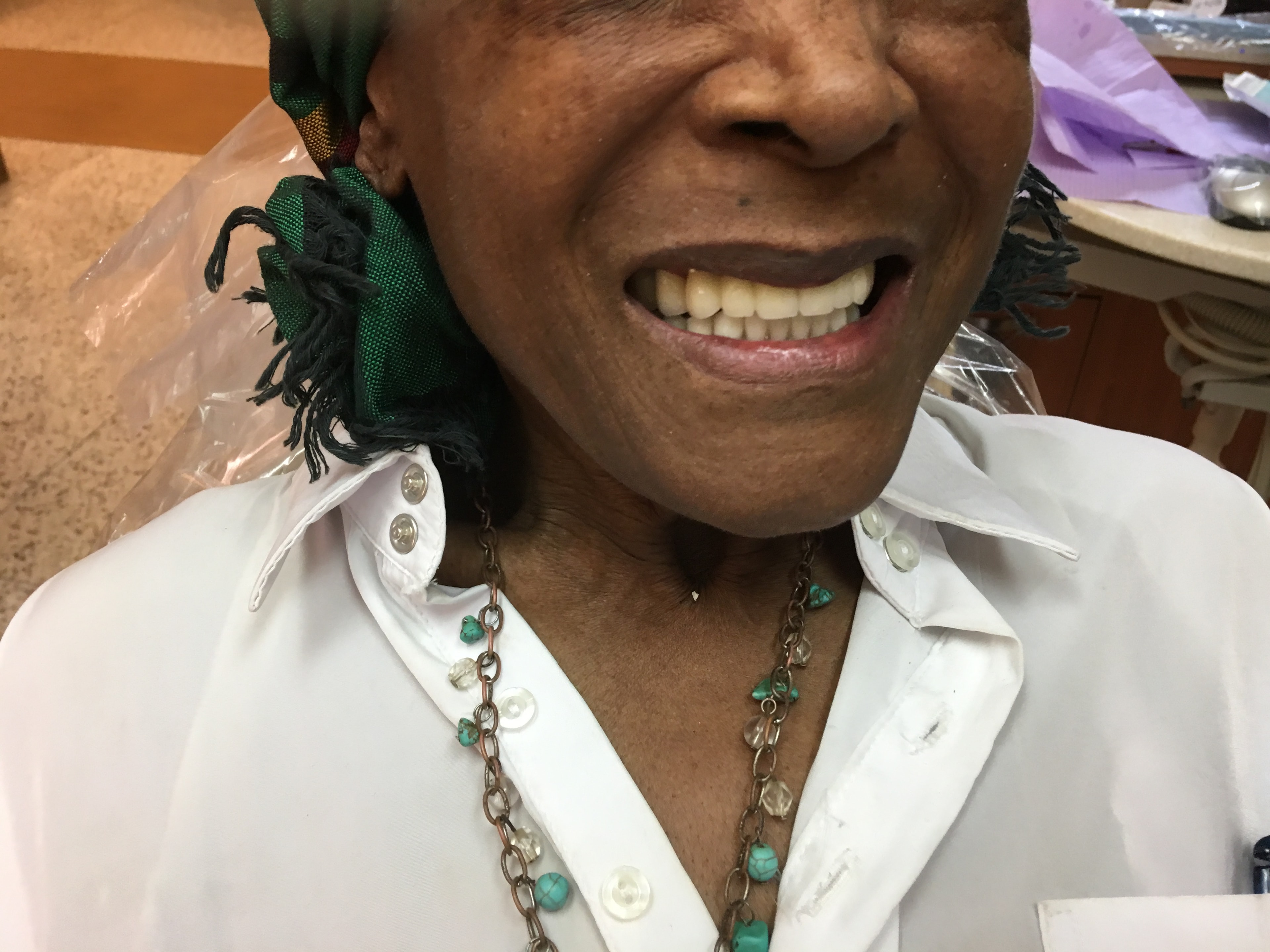 Patient teeth after treatment — Case 4