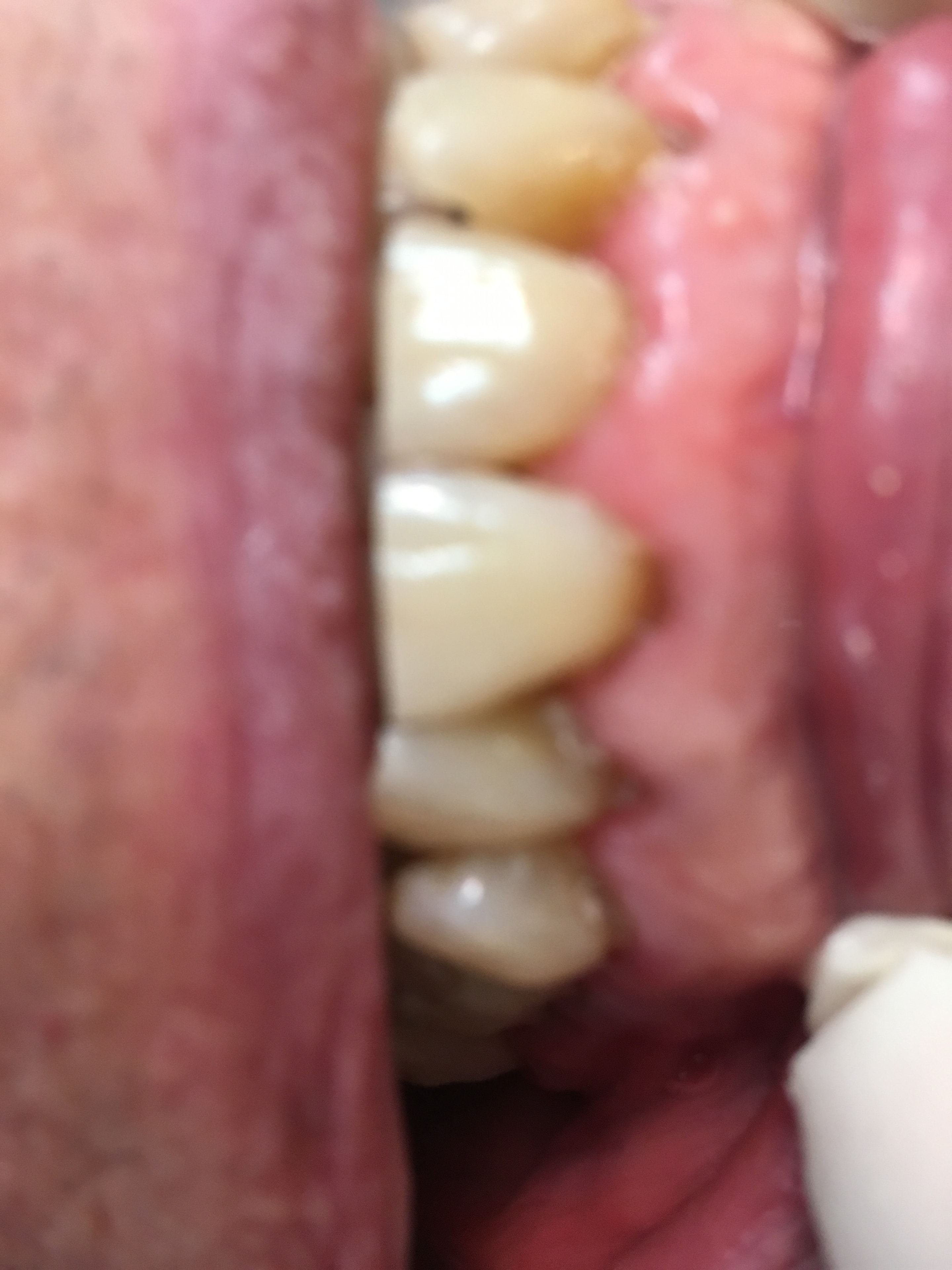 Patient teeth before treatment — Case 3